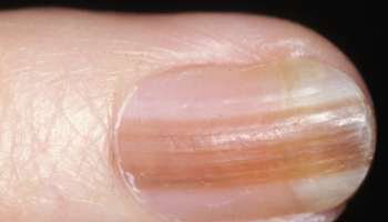 Dermoscopy for nail lesions