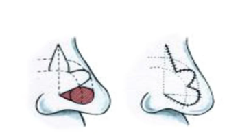 The Bilobed flap
