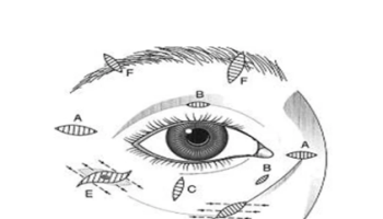 Periorbital defects
