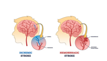 Stroke and Transient Ischaemic attacks (TIAs)